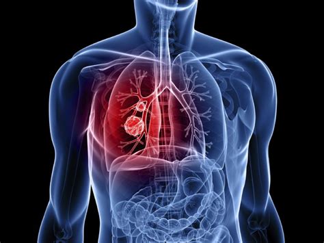bronş ve akciğer malign neoplazmı ne demek